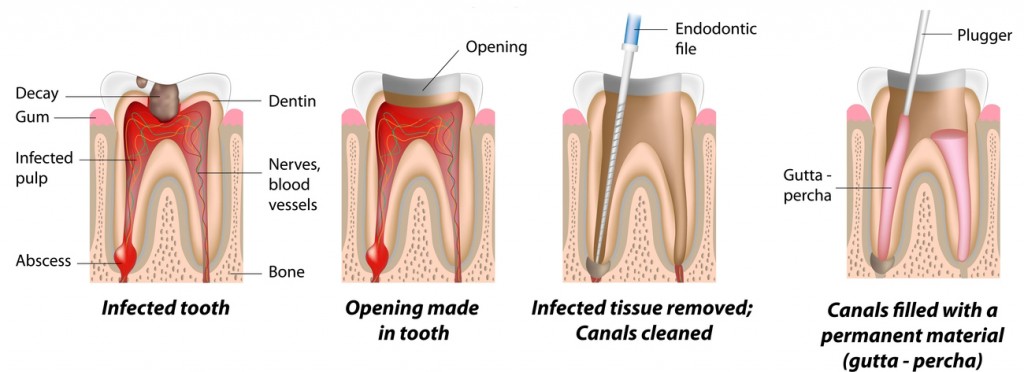 pulpitis and periodontitis